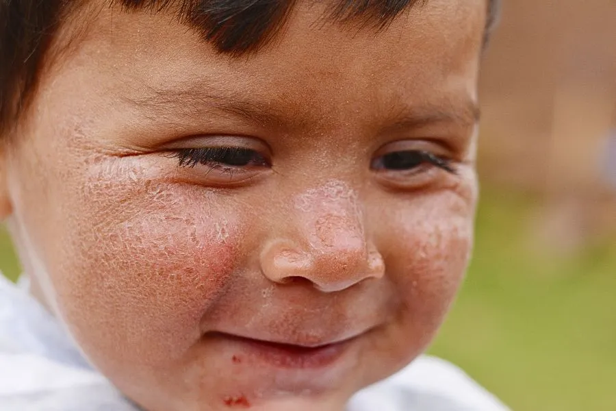 baby with sun-burnt skin smiling
